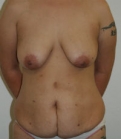 Feel Beautiful - Mommy Makeover San Diego Case 7 - Before Photo